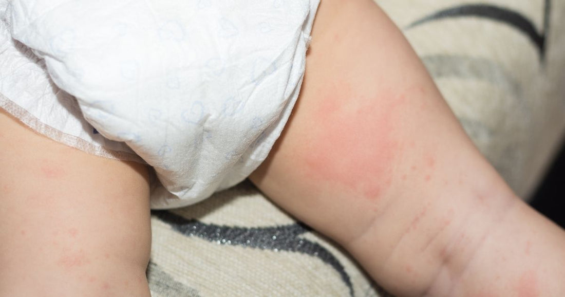 Dermatite de Fralda: Causas, Prevenção e Quando Procurar o Pediatra