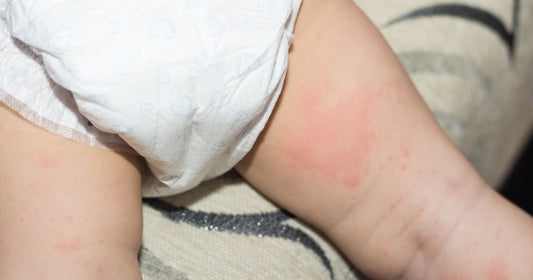 Dermatite de Fralda: Causas, Prevenção e Quando Procurar o Pediatra